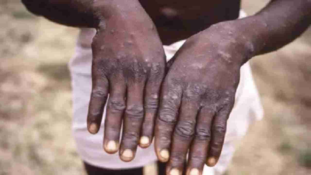 Monkeypox: ಕೇರಳದಲ್ಲಿ ದೇಶದ ಮೊದಲ ಮಂಕಿಪಾಕ್ಸ್​ ಪ್ರಕರಣ ದೃಢ