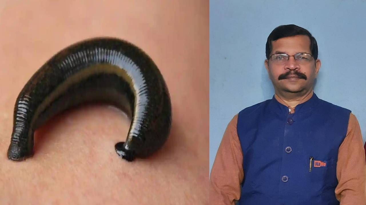 Leech: ಉಂಬಳ ಕಚ್ಚಿದಾಗ ಆಗುವ ರಕ್ತಸ್ರಾವ ತಡೆಯಲು ಏನು ಮಾಡಬೇಕು? Leech: ಉಂಬಳ ಕಚ್ಚಿದಾಗ ಆಗುವ ರಕ್ತಸ್ರಾವ ತಡೆಯಲು ಏನು ಮಾಡಬೇಕು?