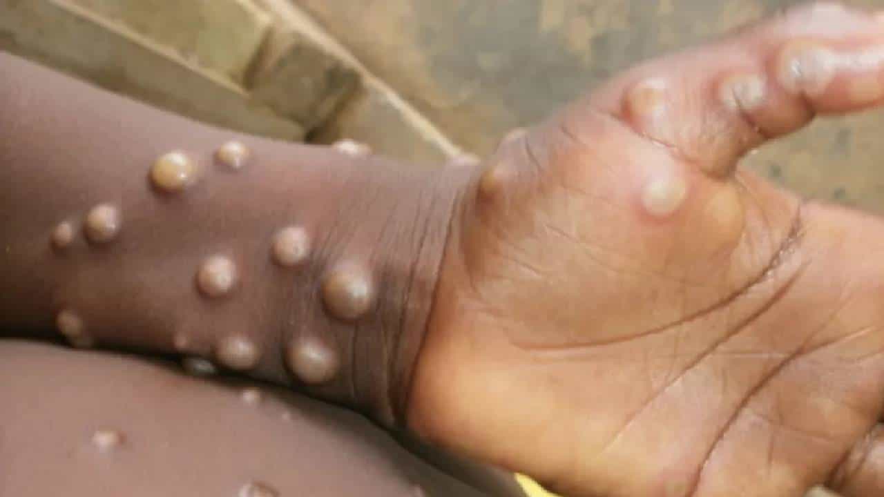 Breaking News: Monkeypox: ಕೇರಳದಲ್ಲಿ ದೇಶದ ಎರಡನೇ ಮಂಕಿಪಾಕ್ಸ್ ಪ್ರಕರಣ ಪತ್ತೆ Breaking News: Monkeypox: ಕೇರಳದಲ್ಲಿ ದೇಶದ ಎರಡನೇ ಮಂಕಿಪಾಕ್ಸ್ ಪ್ರಕರಣ ಪತ್ತೆ