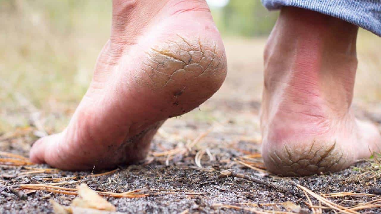 Cracked Heels: ಒಡೆದ ಹಿಮ್ಮಡಿಯನ್ನು ತ್ವರಿತವಾಗಿ ಸರಿಪಡಿಸುವ ಈ ಸುಲಭ ಮನೆಮದ್ದುಗಳ ಬಗ್ಗೆ ತಿಳಿಯಿರಿ Cracked Heels: ಒಡೆದ ಹಿಮ್ಮಡಿಯನ್ನು ತ್ವರಿತವಾಗಿ ಸರಿಪಡಿಸುವ ಈ ಸುಲಭ ಮನೆಮದ್ದುಗಳ ಬಗ್ಗೆ ತಿಳಿಯಿರಿ