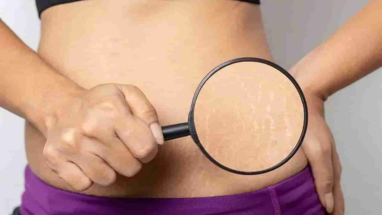 Stretch Marks: ಗರ್ಭಧಾರಣೆ ಹೊರತಾಗಿಯೂ ದೇಹದಲ್ಲಿ ಸ್ಟ್ರೆಚ್ ಮಾರ್ಕ್ಸ್​ ಮೂಡಲು ಕಾರಣಗಳು ಇಲ್ಲಿವೆ