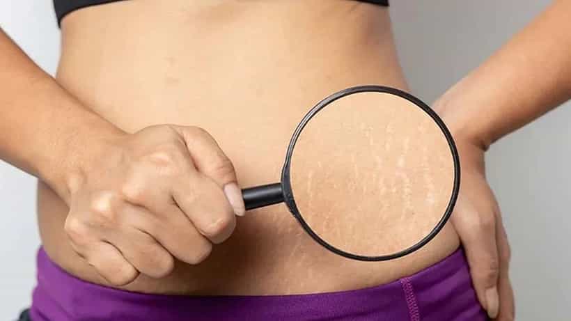 Stretch Marks: ಗರ್ಭಧಾರಣೆ ಹೊರತಾಗಿಯೂ ದೇಹದಲ್ಲಿ ಸ್ಟ್ರೆಚ್ ಮಾರ್ಕ್ಸ್ ಮೂಡಲು ಕಾರಣಗಳು ಇಲ್ಲಿವೆ