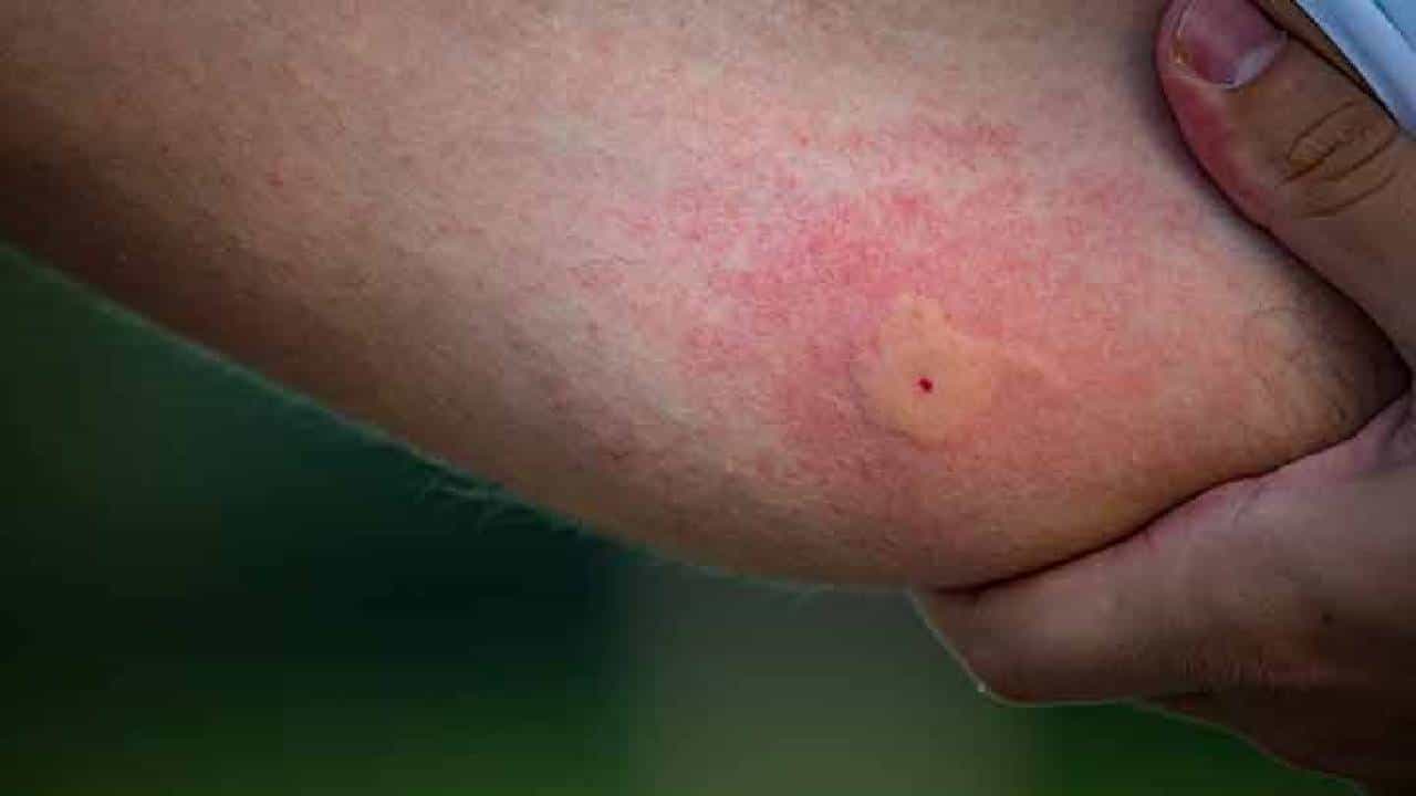 Mosquito Bite Scars: ಸೊಳ್ಳೆ ಕಡಿತದಿಂದ ಉಂಟಾದ ಕಲೆಗಳನ್ನು ದೂರ ಮಾಡಲು ಮನೆಮದ್ದುಗಳು ಇಲ್ಲಿವೆ Mosquito Bite Scars: ಸೊಳ್ಳೆ ಕಡಿತದಿಂದ ಉಂಟಾದ ಕಲೆಗಳನ್ನು ದೂರ ಮಾಡಲು ಮನೆಮದ್ದುಗಳು ಇಲ್ಲಿವೆ