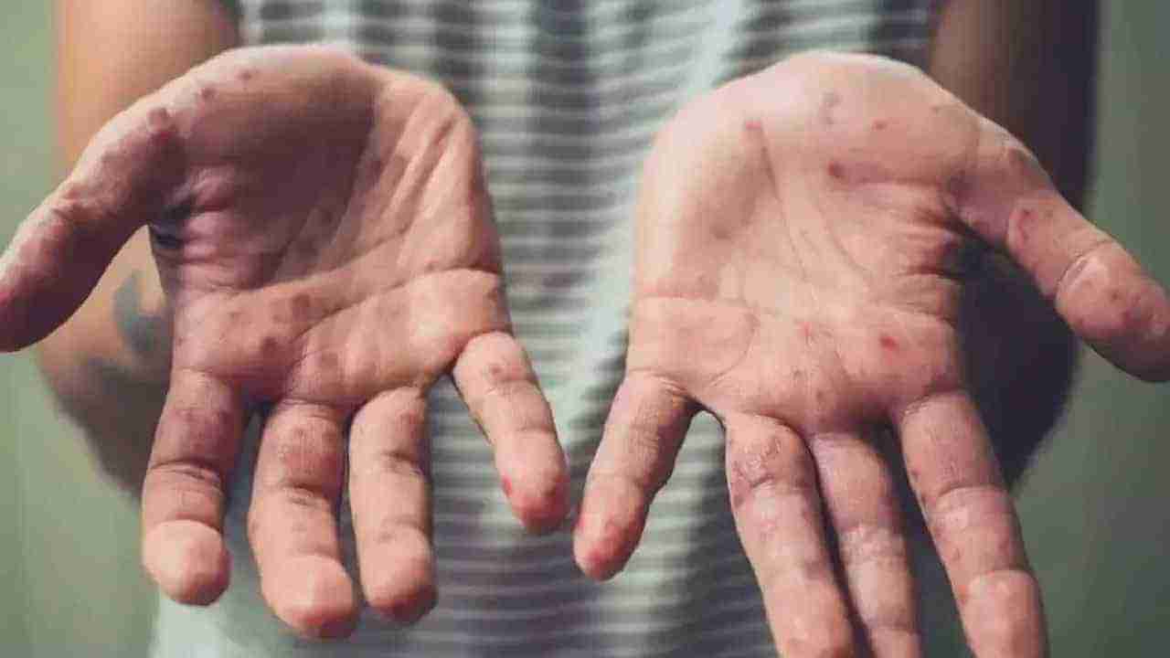 Monkeypox: ಮಕ್ಕಳಿಗೂ ವಕ್ಕರಿಸಿದ ಮಂಕಿಪಾಕ್ಸ್; ಯುಎಸ್ನಲ್ಲಿ ಅಂಬೆಗಾಲಿಡುವ ಮಗುವಿನಲ್ಲಿ ಮಂಕಿಪಾಕ್ಸ್ ಪತ್ತೆ