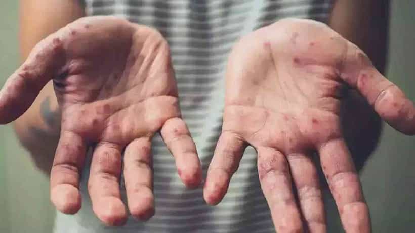 Monkeypox: ಮಕ್ಕಳಿಗೂ ವಕ್ಕರಿಸಿದ ಮಂಕಿಪಾಕ್ಸ್; ಯುಎಸ್ನಲ್ಲಿ ಅಂಬೆಗಾಲಿಡುವ ಮಗುವಿನಲ್ಲಿ ಮಂಕಿಪಾಕ್ಸ್ ಪತ್ತೆ