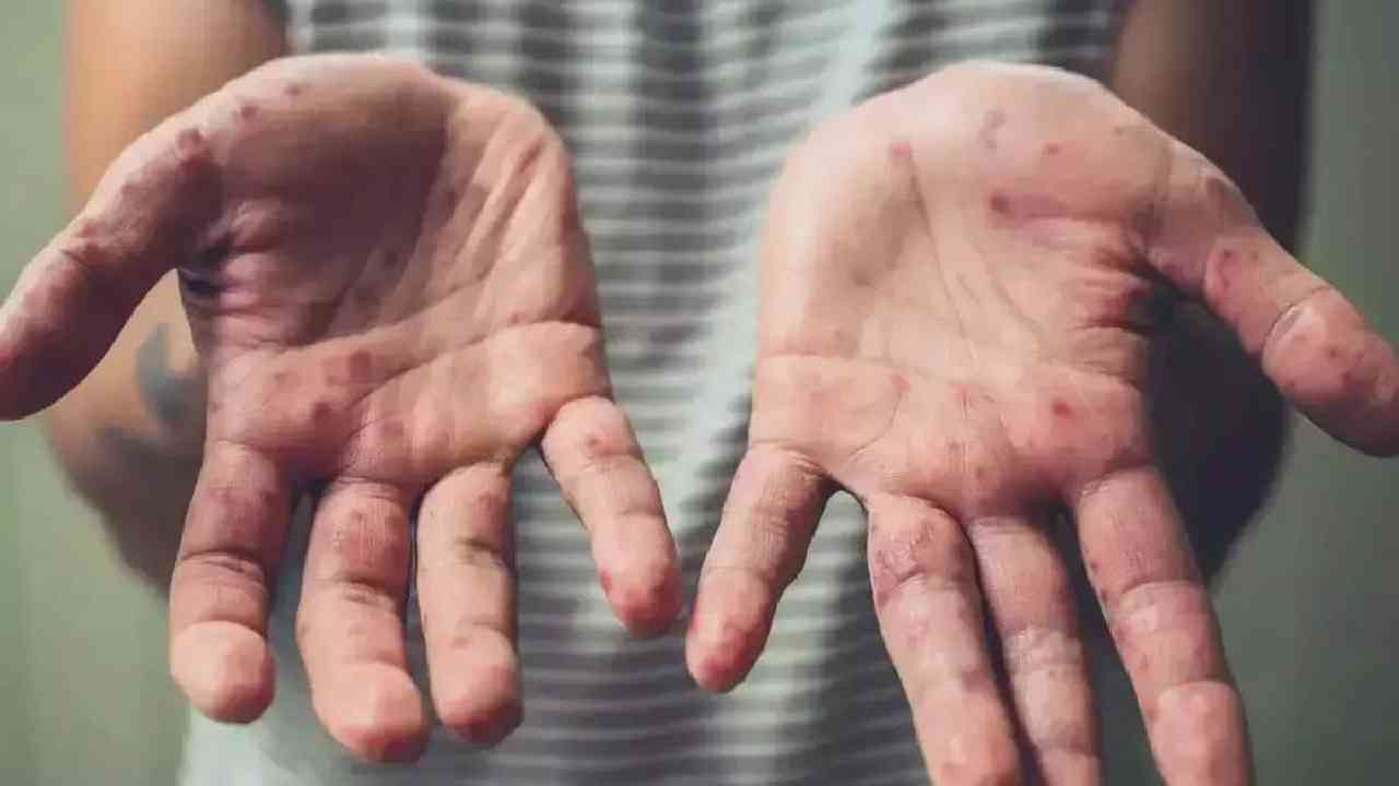 Monkeypox: ಮಕ್ಕಳಿಗೂ ವಕ್ಕರಿಸಿದ ಮಂಕಿಪಾಕ್ಸ್; ಯುಎಸ್ನಲ್ಲಿ ಅಂಬೆಗಾಲಿಡುವ ಮಗುವಿನಲ್ಲಿ ಮಂಕಿಪಾಕ್ಸ್ ಪತ್ತೆ Monkeypox: ಮಕ್ಕಳಿಗೂ ವಕ್ಕರಿಸಿದ ಮಂಕಿಪಾಕ್ಸ್; ಯುಎಸ್ನಲ್ಲಿ ಅಂಬೆಗಾಲಿಡುವ ಮಗುವಿನಲ್ಲಿ ಮಂಕಿಪಾಕ್ಸ್ ಪತ್ತೆ