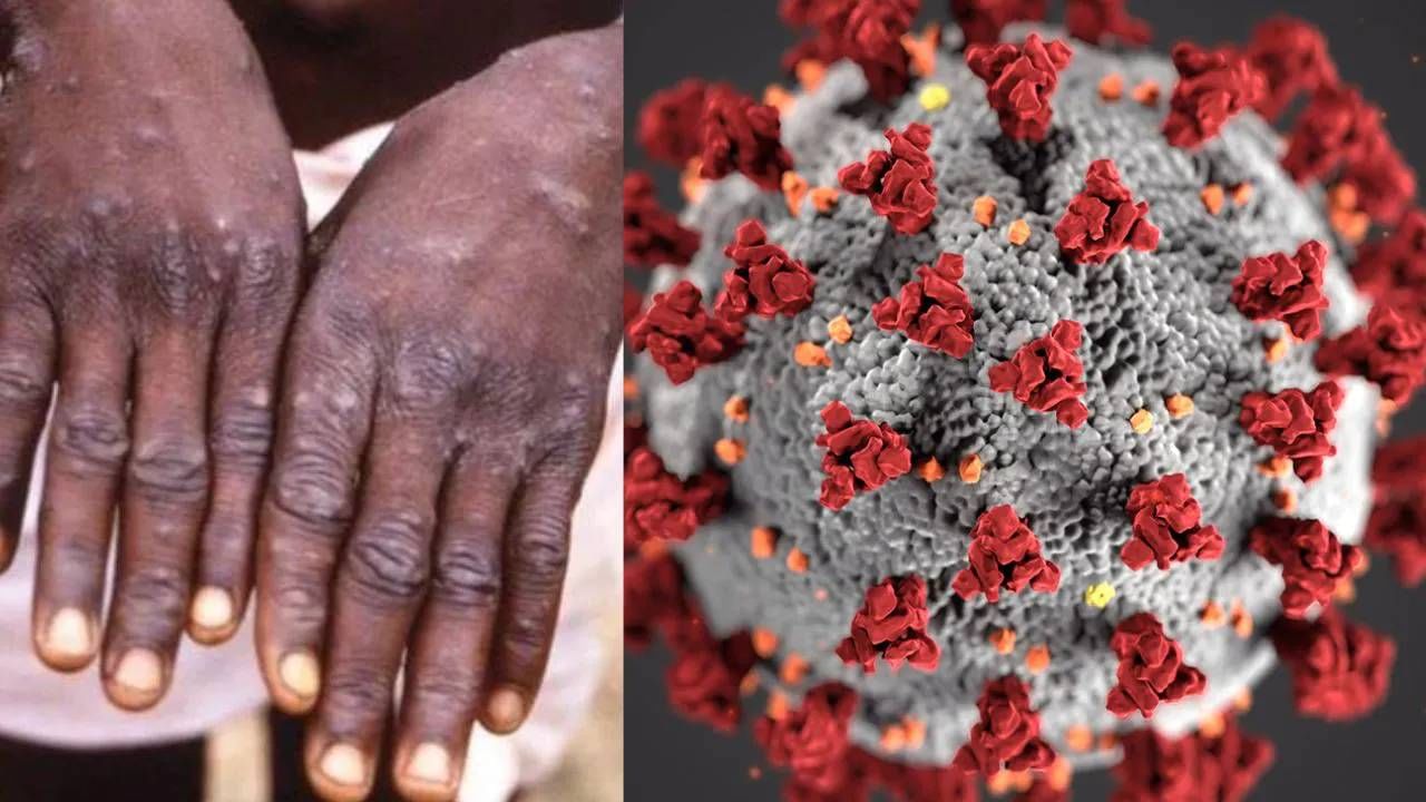 Monkeypox VS Covid 19: ಮಂಕಿಪಾಕ್ಸ್​  ಹಾಗೂ ಕೋವಿಡ್-19 ನಡುವೆ ಸಾಮ್ಯತೆ ಇದೆಯೇ?