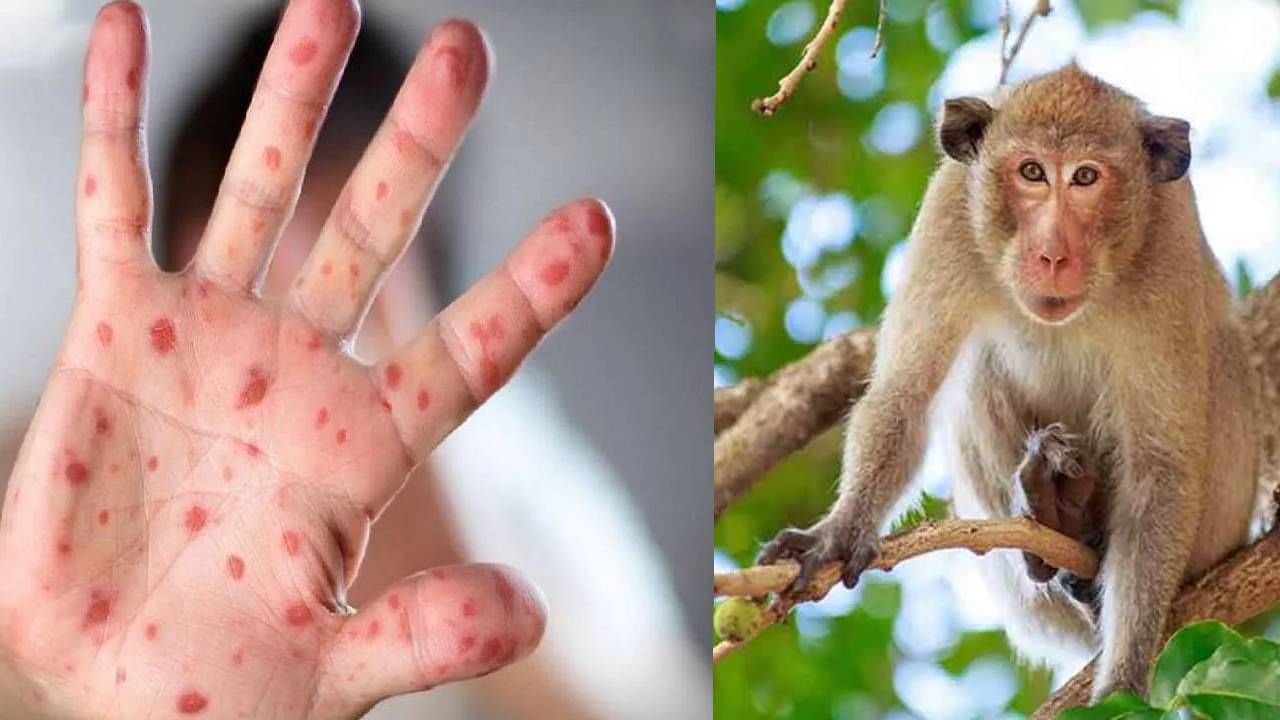 Monkeypox: ಮಂಕಿಪಾಕ್ಸ್ಗೂ ಮಂಗಗಳಿಗೂ ಸಂಬಂಧವಿದೆಯೇ? ವೈರಸ್ಗೆ ಮಂಕಿಪಾಕ್ಸ್ ಎಂದು ಹೆಸರು ಬರಲು ಕಾರಣವೇನು? Monkeypox: ಮಂಕಿಪಾಕ್ಸ್ಗೂ ಮಂಗಗಳಿಗೂ ಸಂಬಂಧವಿದೆಯೇ? ವೈರಸ್ಗೆ ಮಂಕಿಪಾಕ್ಸ್ ಎಂದು ಹೆಸರು ಬರಲು ಕಾರಣವೇನು?