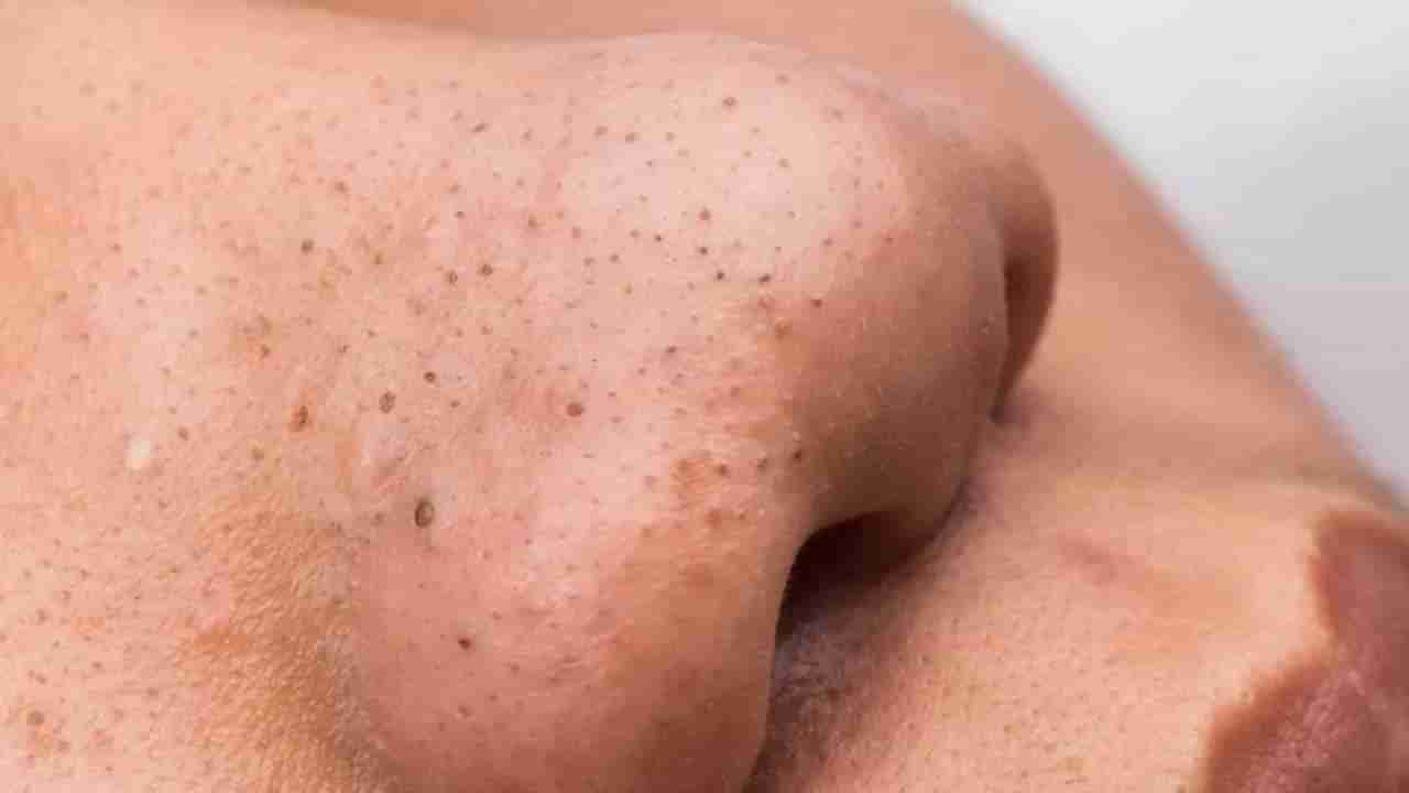 Blackheads: ಟೊಮೆಟೊದಿಂದ ಮುಖದಲ್ಲಿರುವ ಬ್ಲ್ಯಾಕ್​ಹೆಡ್ಸ್​ನ್ನು ದೂರ ಮಾಡಬಹುದು, ವಿಧಾನ ತಿಳಿಯಿರಿ