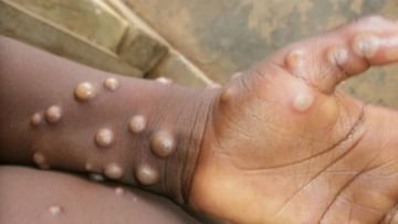 Monkeypox: ಭಾರತದ ಮೊದಲ ಮಂಕಿಪಾಕ್ಸ್ ಸೋಂಕಿತ ಗುಣಮುಖ