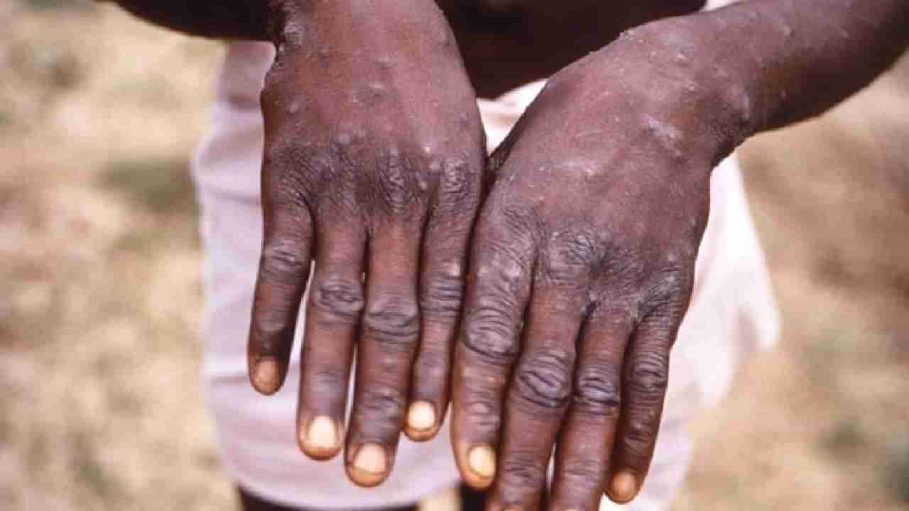 Monkeypox: ಭಾರತಕ್ಕೂ ಲಗ್ಗೆಯಿಟ್ಟ ಮಂಕಿಪಾಕ್ಸ್​; ಈ ಸೋಂಕಿನಿಂದ ಪಾರಾಗಲು ಏನು ಮಾಡಬೇಕು?