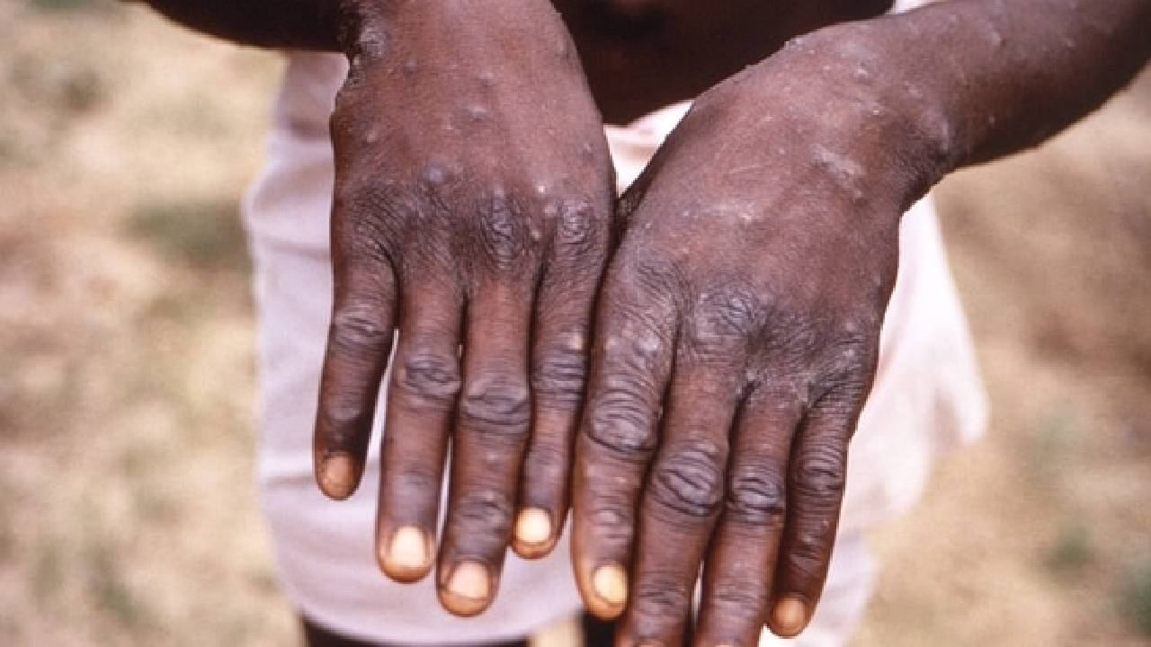 Monkeypox: ಭಾರತಕ್ಕೂ ಲಗ್ಗೆಯಿಟ್ಟ ಮಂಕಿಪಾಕ್ಸ್; ಈ ಸೋಂಕಿನಿಂದ ಪಾರಾಗಲು ಏನು ಮಾಡಬೇಕು? Monkeypox: ಭಾರತಕ್ಕೂ ಲಗ್ಗೆಯಿಟ್ಟ ಮಂಕಿಪಾಕ್ಸ್; ಈ ಸೋಂಕಿನಿಂದ ಪಾರಾಗಲು ಏನು ಮಾಡಬೇಕು?