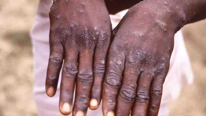 Monkeypox Case: ಕಾಮರೆಡ್ಡಿಯಲ್ಲಿ ತೆಲಂಗಾಣದ ಮೊದಲ ಮಂಕಿಪಾಕ್ಸ್ ಪ್ರಕರಣ ಪತ್ತೆ