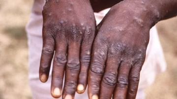 Monkeypox Case: ಕಾಮರೆಡ್ಡಿಯಲ್ಲಿ ತೆಲಂಗಾಣದ ಮೊದಲ ಮಂಕಿಪಾಕ್ಸ್​​ ಪ್ರಕರಣ ಪತ್ತೆ