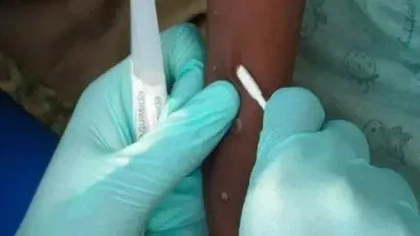 Monkeypox Symptoms: ಮಂಕಿಪಾಕ್ಸ್ ಸೋಂಕಿನ ರೋಗಲಕ್ಷಣಗಳು ಈಗ ಮೊದಲಿನಂತಿಲ್ಲ