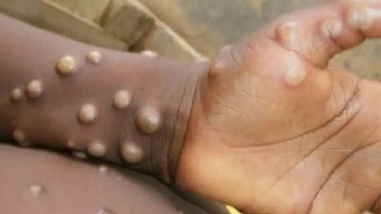 Kerala Monkeypox: ಕೇರಳದಲ್ಲಿ ಭಾರತದಲ್ಲೇ ಮೊದಲ ಮಂಕಿಪಾಕ್ಸ್ ಕೇಸ್ ಪತ್ತೆ; ಕರ್ನಾಟಕದಲ್ಲೂ ಹೆಚ್ಚಿದ ಆತಂಕ Kerala Monkeypox: ಕೇರಳದಲ್ಲಿ ಭಾರತದಲ್ಲೇ ಮೊದಲ ಮಂಕಿಪಾಕ್ಸ್ ಕೇಸ್ ಪತ್ತೆ; ಕರ್ನಾಟಕದಲ್ಲೂ ಹೆಚ್ಚಿದ ಆತಂಕ