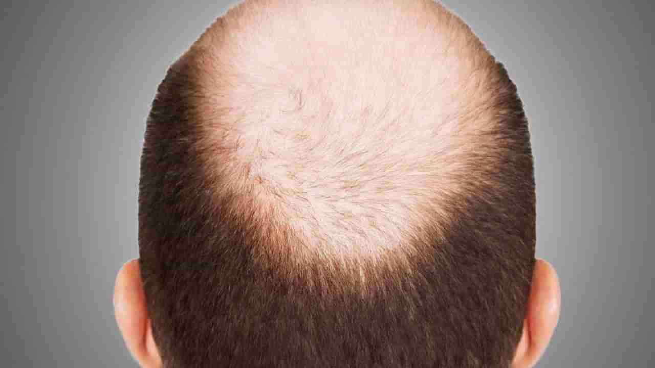 Baldness: ಈ ಆಹಾರಗಳಿಂದ ದೂರವಿರಿ, ಇಲ್ಲವೆಂದಾದರೆ ಕೂದಲು ಉದುರುವುದು ಗ್ಯಾರಂಟಿ!