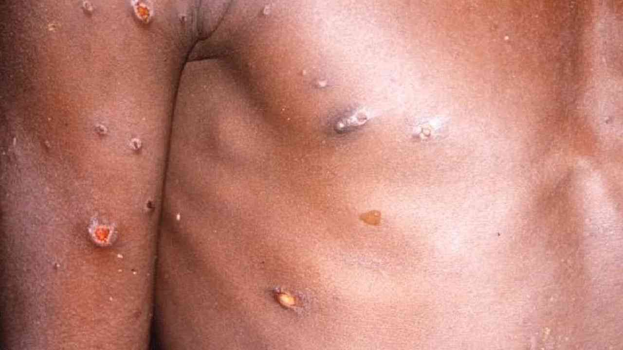 MonkeyPox: ಮಂಕಿಪಾಕ್ಸ್​​ ರೋಗಿಗಳಿಗೆ ಆಯುರ್ವೇದ ವೈದ್ಯರು ನೀಡಿದ ಸಲಹೆಗಳು ಇಲ್ಲಿವೆ