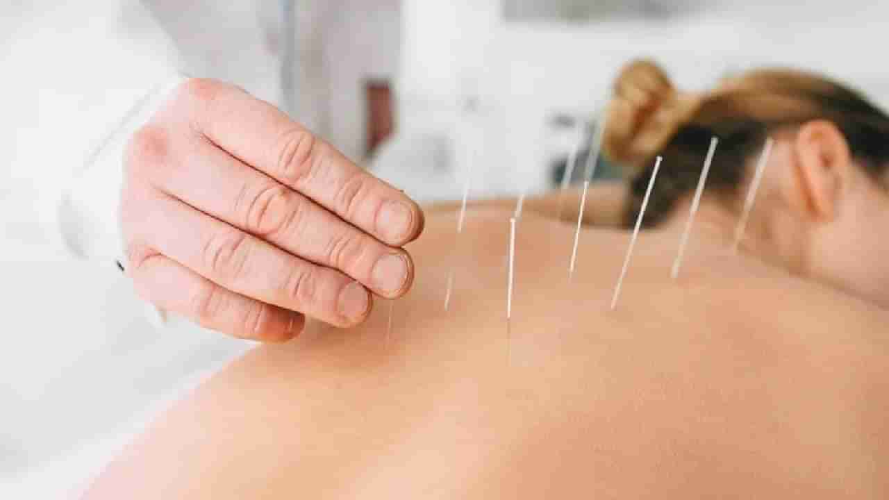 Acupuncture Therapy: ಆಕ್ಯುಪಂಕ್ಚರ್​ ಥೆರಪಿಯಿಂದ ಮಧುಮೇಹ ನಿಯಂತ್ರಣ ಸಾಧ್ಯ: ಅಧ್ಯಯನ