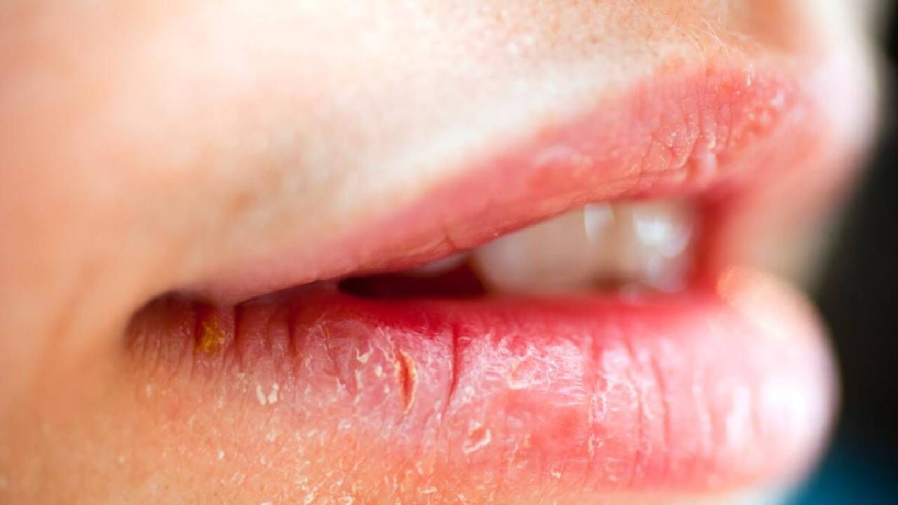 Angular Cheilitis: ನಿಮ್ಮ ತುಟಿಗಳ ಮೂಲೆಯಲ್ಲಿ ಬಿರುಕು ಬಿಡುತ್ತಿದೆಯೇ? ಈ ರೋಗದ ಲಕ್ಷಣವಾಗಿರಬಹುದು Angular Cheilitis: ನಿಮ್ಮ ತುಟಿಗಳ ಮೂಲೆಯಲ್ಲಿ ಬಿರುಕು ಬಿಡುತ್ತಿದೆಯೇ? ಈ ರೋಗದ ಲಕ್ಷಣವಾಗಿರಬಹುದು
