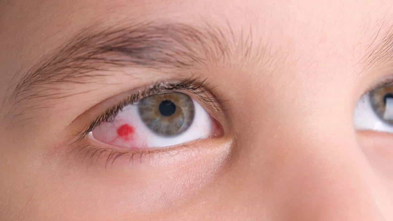 Eye Bleeding: ಕಣ್ಣಿನಲ್ಲಿ ರಕ್ತಸ್ರಾವ: ಕಾರಣ, ವಿಧಗಳು, ಲಕ್ಷಣಗಳು ಮತ್ತು ಚಿಕಿತ್ಸೆಗಳೇನು? Eye Bleeding: ಕಣ್ಣಿನಲ್ಲಿ ರಕ್ತಸ್ರಾವ: ಕಾರಣ, ವಿಧಗಳು, ಲಕ್ಷಣಗಳು ಮತ್ತು ಚಿಕಿತ್ಸೆಗಳೇನು?