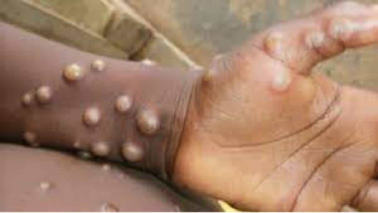 Monkeypox: ದೆಹಲಿಯಲ್ಲಿ 5ನೇ ಮಂಕಿಪಾಕ್ಸ್ ಪ್ರಕರಣ ಪತ್ತೆ Monkeypox: ದೆಹಲಿಯಲ್ಲಿ 5ನೇ ಮಂಕಿಪಾಕ್ಸ್ ಪ್ರಕರಣ ಪತ್ತೆ