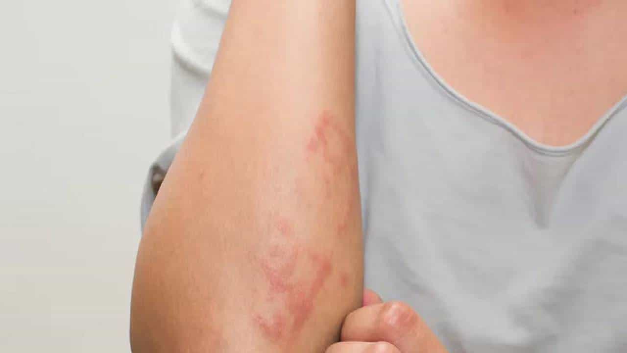 Allergy: ಮನೆಯ ವಸ್ತುಗಳು ನಿಮಗೆ ಅಲರ್ಜಿ ಉಂಟು ಮಾಡುತ್ತವೆಯೇ? ಪರಿಹಾರವೇನು? Allergy: ಮನೆಯ ವಸ್ತುಗಳು ನಿಮಗೆ ಅಲರ್ಜಿ ಉಂಟು ಮಾಡುತ್ತವೆಯೇ? ಪರಿಹಾರವೇನು?