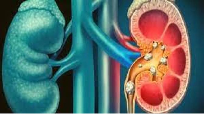 Kidney Stone: ಮೂತ್ರಪಿಂಡದ ಕಲ್ಲು ಇದ್ದಾಗ ದೇಹದಲ್ಲಿ ಈ ಚಿಹ್ನೆಗಳು ಗೋಚರಿಸುತ್ತೆ, ನಿರ್ಲಕ್ಷಿಸಬೇಡಿ Kidney Stone: ಮೂತ್ರಪಿಂಡದ ಕಲ್ಲು ಇದ್ದಾಗ ದೇಹದಲ್ಲಿ ಈ ಚಿಹ್ನೆಗಳು ಗೋಚರಿಸುತ್ತೆ, ನಿರ್ಲಕ್ಷಿಸಬೇಡಿ