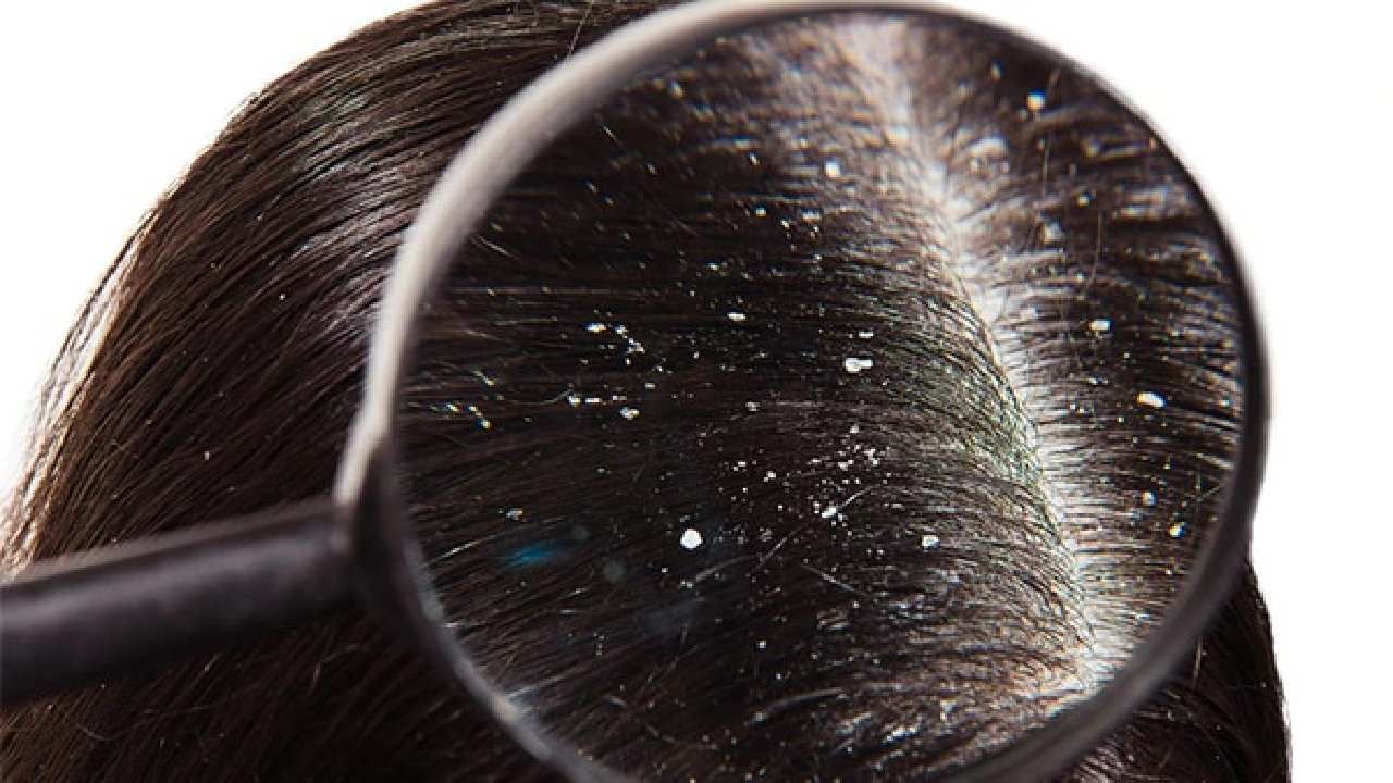 Dandruff: ಎಣ್ಣೆಯುಕ್ತ ಡ್ಯಾಂಡ್ರಫ್​ ಸಮಸ್ಯೆ ಎದುರಿಸುತ್ತಿದ್ದೀರಾ? ಹಾಗಾದರೆ ಇಲ್ಲಿದೆ ಸರಳ ವಿಧಾನ