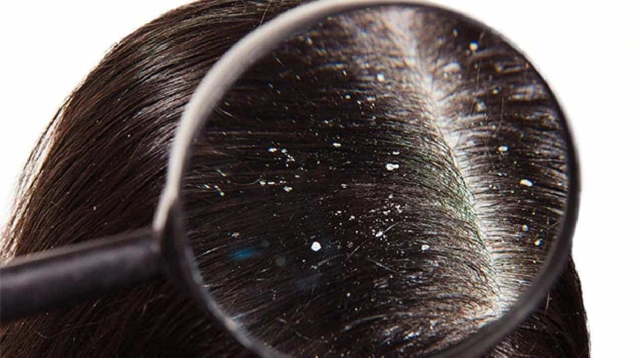Dandruff: ಎಣ್ಣೆಯುಕ್ತ ಡ್ಯಾಂಡ್ರಫ್ ಸಮಸ್ಯೆ ಎದುರಿಸುತ್ತಿದ್ದೀರಾ? ಹಾಗಾದರೆ ಇಲ್ಲಿದೆ ಸರಳ ವಿಧಾನ Dandruff: ಎಣ್ಣೆಯುಕ್ತ ಡ್ಯಾಂಡ್ರಫ್ ಸಮಸ್ಯೆ ಎದುರಿಸುತ್ತಿದ್ದೀರಾ? ಹಾಗಾದರೆ ಇಲ್ಲಿದೆ ಸರಳ ವಿಧಾನ