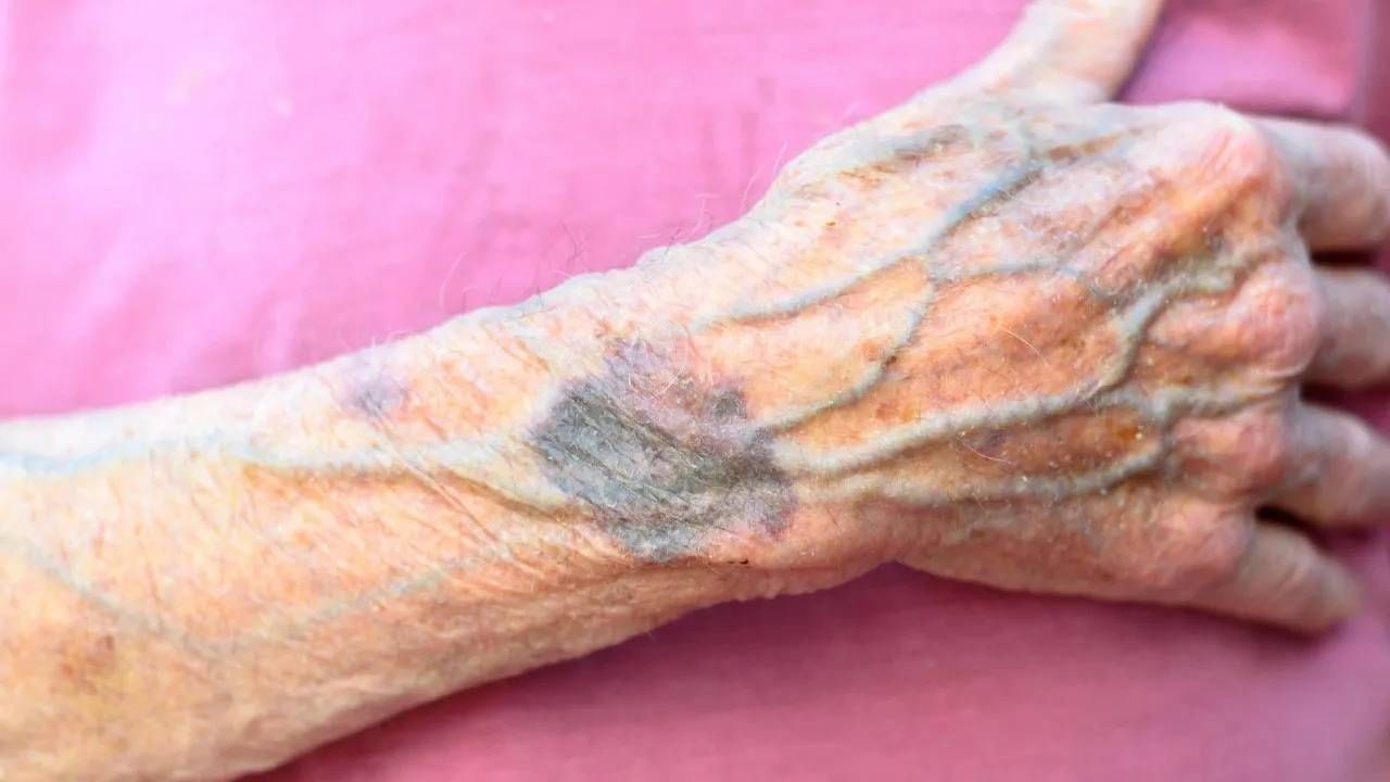 Hand Veins: ನಿಮ್ಮ ಕೈಯಲ್ಲಿ ಉಬ್ಬಿದ ನರಗಳು ಗೋಚರಿಸುತ್ತಿವೆಯೇ? ಕಾರಣವೇನು?