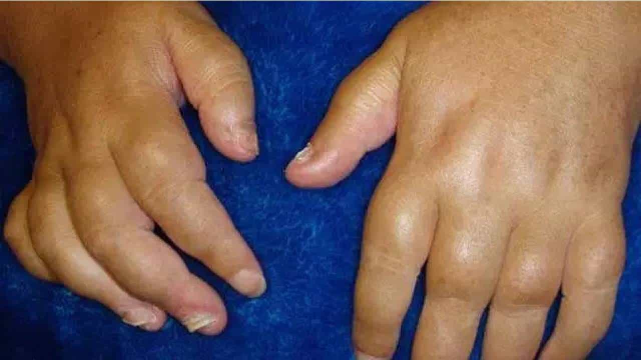 Swollen Hands: ಬೆಳಗ್ಗೆ ಎದ್ದಾಗ ನಿಮ್ಮ ಕೈಗಳಲ್ಲಿ ಊತ ಕಾಣಿಸುತ್ತಿದೆಯೇ? ನಿಮಗೆ ಈ ಸಮಸ್ಯೆಗಳು ಇರಬಹುದು Swollen Hands: ಬೆಳಗ್ಗೆ ಎದ್ದಾಗ ನಿಮ್ಮ ಕೈಗಳಲ್ಲಿ ಊತ ಕಾಣಿಸುತ್ತಿದೆಯೇ? ನಿಮಗೆ ಈ ಸಮಸ್ಯೆಗಳು ಇರಬಹುದು