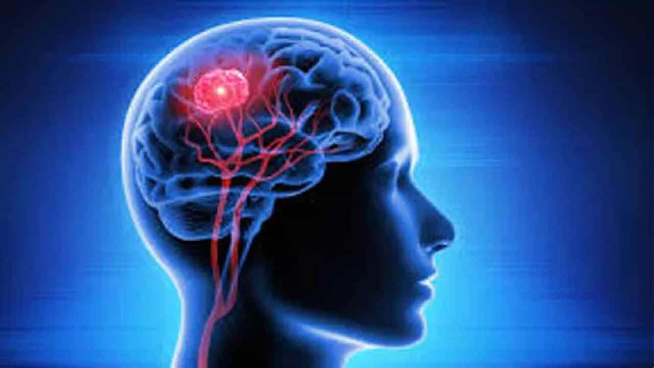 Brain Tumour: ಬ್ರೈನ್ ಟ್ಯೂಮರ್ ಪತ್ತೆ ಮಾಡುವುದು ಹೇಗೆ? ಲಕ್ಷಣಗಳೇನು? Brain Tumour: ಬ್ರೈನ್ ಟ್ಯೂಮರ್ ಪತ್ತೆ ಮಾಡುವುದು ಹೇಗೆ? ಲಕ್ಷಣಗಳೇನು?
