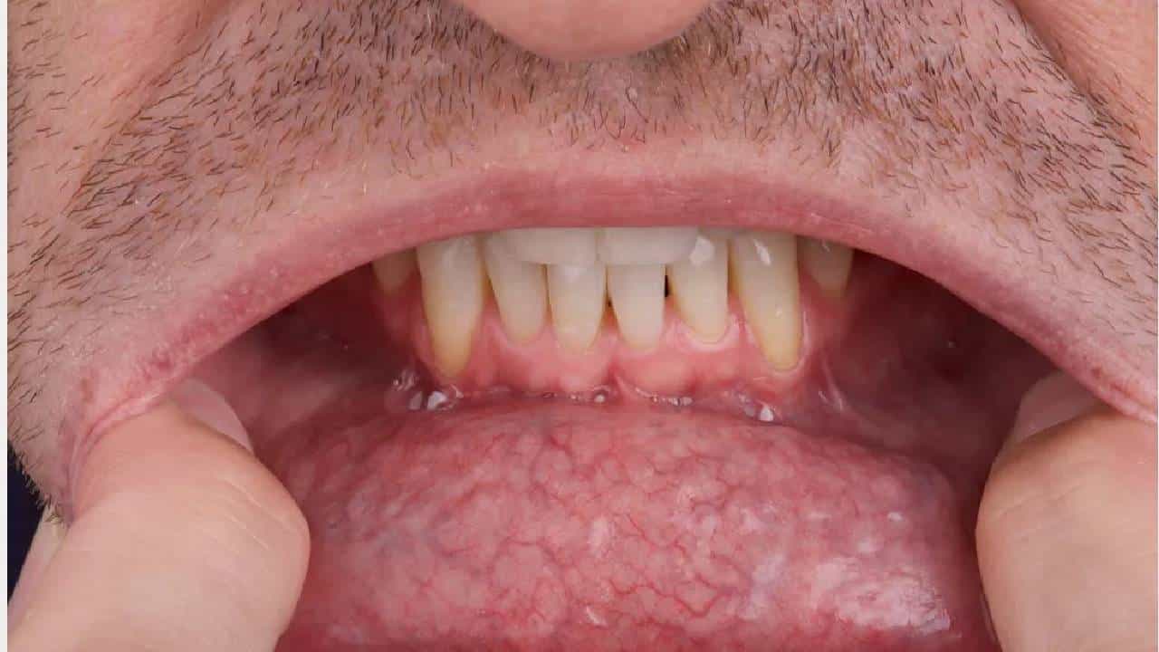 Oral Cancer: ಬಾಯಿಯ ಕ್ಯಾನ್ಸರ್ನ ಲಕ್ಷಣಗಳು, ಕಾರಣಗಳು, ಚಿಕಿತ್ಸೆಗಳೇನು? Oral Cancer: ಬಾಯಿಯ ಕ್ಯಾನ್ಸರ್ನ ಲಕ್ಷಣಗಳು, ಕಾರಣಗಳು, ಚಿಕಿತ್ಸೆಗಳೇನು?
