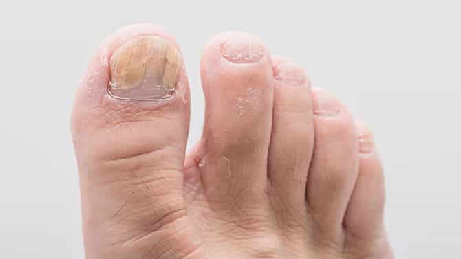 Onychomycosis: ಉಗುರುಗಳಲ್ಲಿ ಕಾಣಿಸಿಕೊಳ್ಳುವ ಫಂಗಸ್​ಗೆ ಇಲ್ಲಿವೆ ಸರಳ ಮನೆಮದ್ದುಗಳು