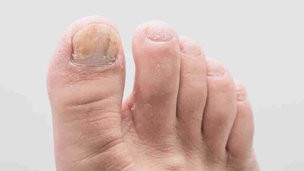 Onychomycosis: ಉಗುರುಗಳಲ್ಲಿ ಕಾಣಿಸಿಕೊಳ್ಳುವ ಫಂಗಸ್​ಗೆ ಇಲ್ಲಿವೆ ಸರಳ ಮನೆಮದ್ದುಗಳು