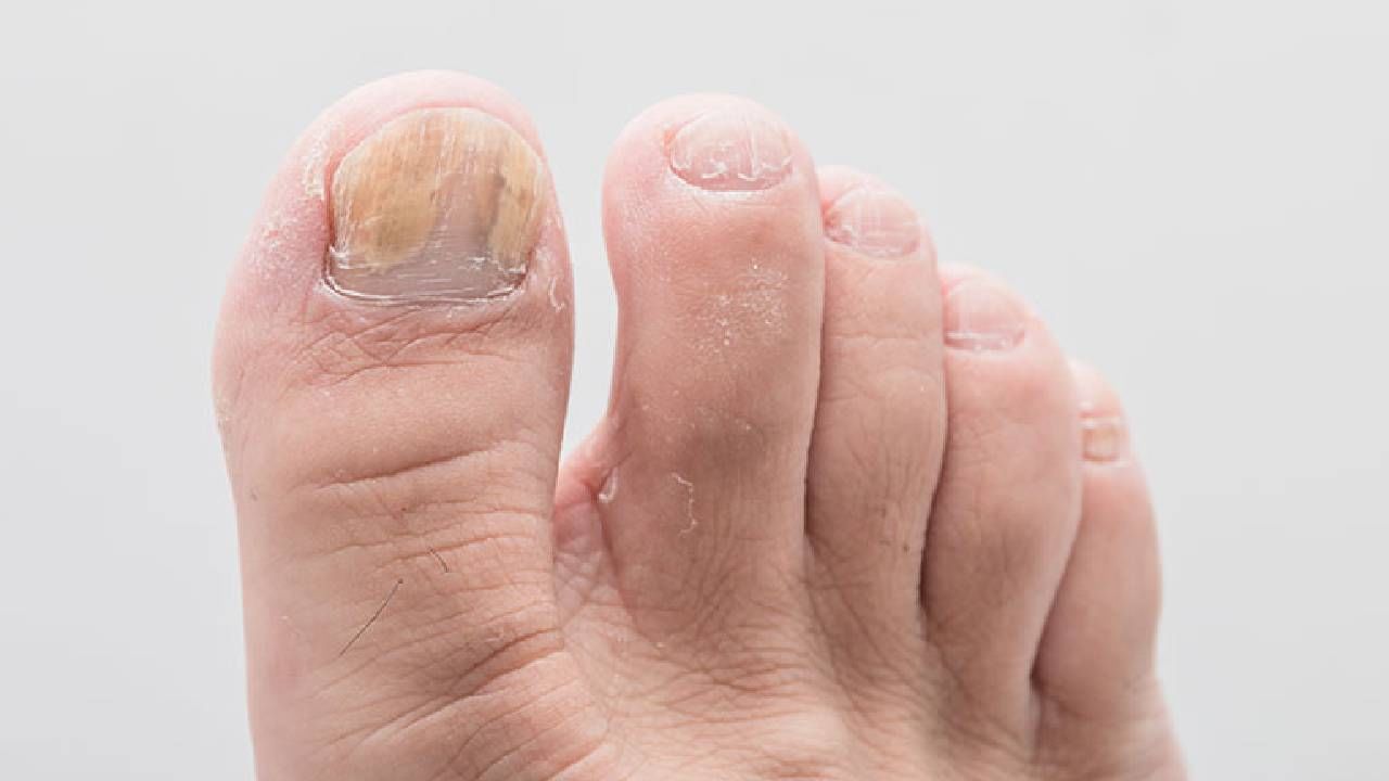 Onychomycosis: ಉಗುರುಗಳಲ್ಲಿ ಕಾಣಿಸಿಕೊಳ್ಳುವ ಫಂಗಸ್​ಗೆ ಇಲ್ಲಿವೆ ಸರಳ ಮನೆಮದ್ದುಗಳು