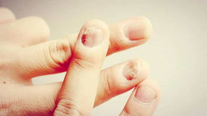 Nail Fungus: ನಿಮಗೂ ಉಗುರು ಸುತ್ತಿನ ಸಮಸ್ಯೆ ಬಾಧಿಸುತ್ತಿದೆಯೇ? ನಿವಾರಣೆಗೆ ಇಲ್ಲಿದೆ ಸುಲಭ ಮನೆಮದ್ದುಗಳು