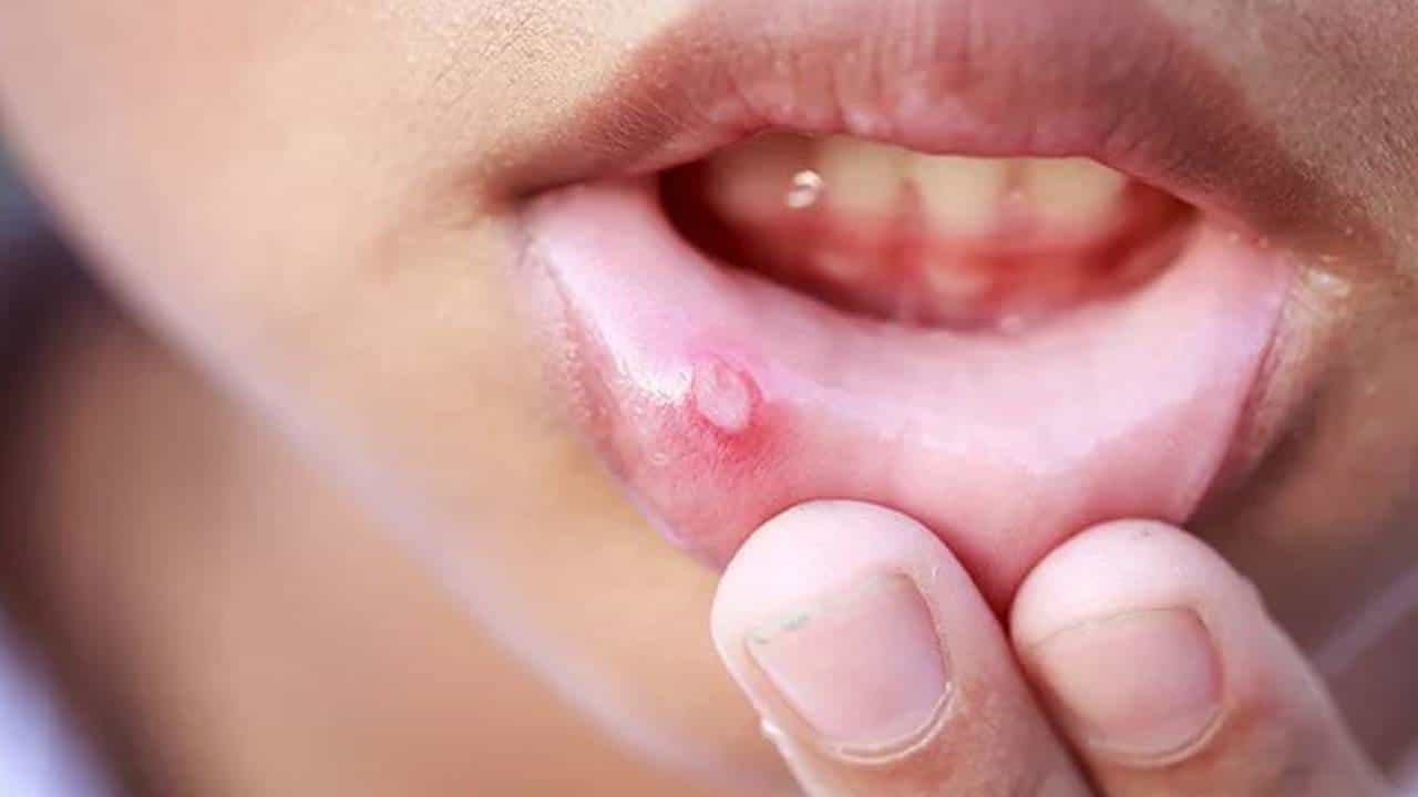 Mouth Ulcers: ಬಾಯಿ ಹುಣ್ಣು ವಾರವಾದರೂ ವಾಸಿಯಾಗುತ್ತಿಲ್ಲವೇ? ಈ ಟಿಪ್ಸ್ ಬಳಸಿ, ಬೇಗ ಗುಣವಾಗುತ್ತೆ Mouth Ulcers: ಬಾಯಿ ಹುಣ್ಣು ವಾರವಾದರೂ ವಾಸಿಯಾಗುತ್ತಿಲ್ಲವೇ? ಈ ಟಿಪ್ಸ್ ಬಳಸಿ, ಬೇಗ ಗುಣವಾಗುತ್ತೆ