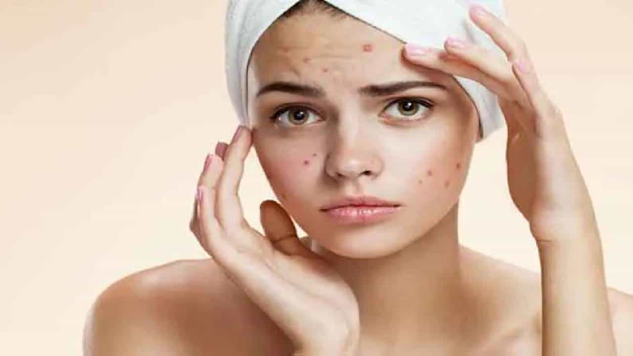 Home Remedies For Pimples: ಈ 4 ವಸ್ತುಗಳನ್ನು ಬಳಸಿ ನೈಸರ್ಗಿಕವಾಗಿ ಮೊಡವೆಗಳನ್ನು ಹೋಗಲಾಡಿಸಿ Home Remedies For Pimples: ಈ 4 ವಸ್ತುಗಳನ್ನು ಬಳಸಿ ನೈಸರ್ಗಿಕವಾಗಿ ಮೊಡವೆಗಳನ್ನು ಹೋಗಲಾಡಿಸಿ