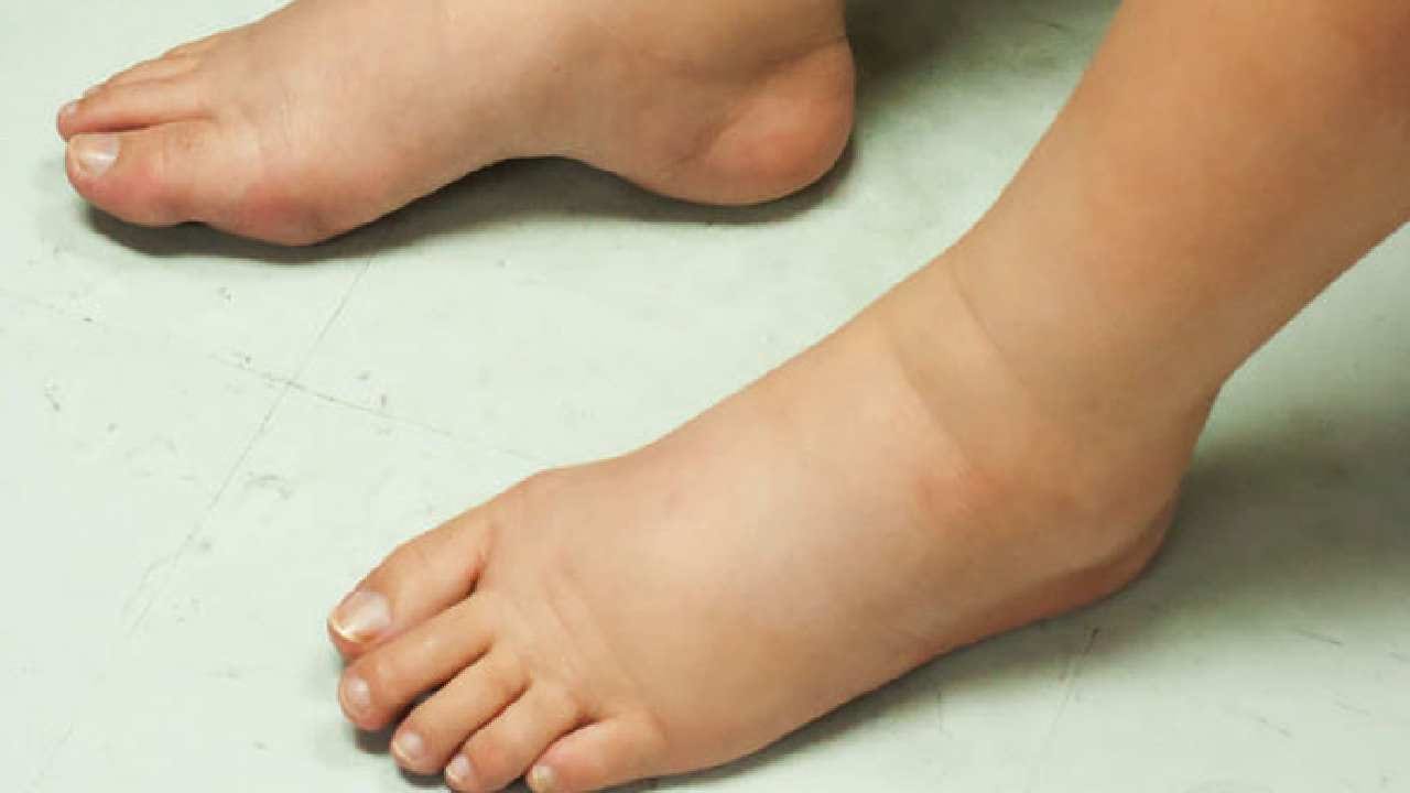 Home Remedies ಪದೇ ಪದೇ ಊದಿಕೊಳ್ಳುವ ಪಾದಗಳಿಗೆ ಇಲ್ಲಿದೆ ಪರಿಹಾರ! Kannada