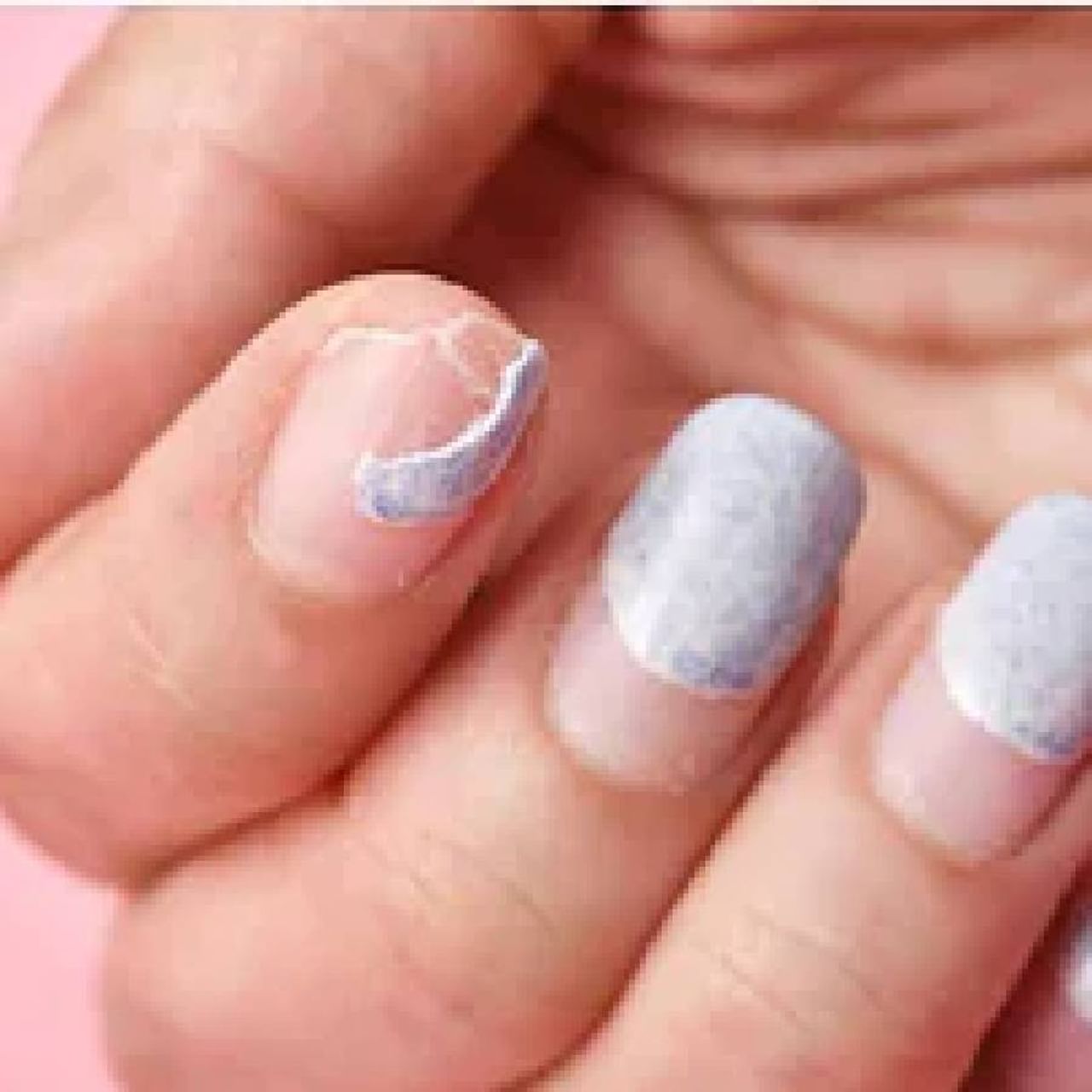 ದುರ್ಬಲವಾದ ಉಗುರುಗಳು(Brittle nails): ಪೋಷಣೆಯ ಕೊರತೆ, ವಿಟಮಿನ್ ಎ, ಸಿ ಕೊರತೆವು ದುರ್ಬಲವಾದ ಉಗುರುಗಳಿಗೆ ಕಾರಣವಾಗುತ್ತದೆ. ಇಂತಹ ಉಗುರುಗಳು ತುಂಬಾ ಮೃದುವಾಗಿದ್ದು ಬೇಗ ಮುರಿಯುವ ಸಾಧ್ಯತೆ ಇದೆ.