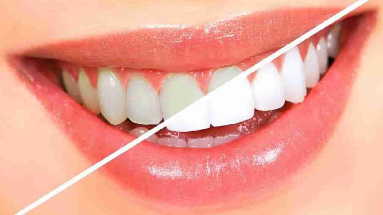 Teeth Whitening: ಬಾಯಿಯ ದುರ್ವಾಸನೆ ಮತ್ತು ಹಳದಿ ಹಲ್ಲುಗಳಿಗೆ ಇಲ್ಲಿವೆ ನೈಸರ್ಗಿಕವಾಗಿ ಮನೆಮದ್ದುಗಳು!