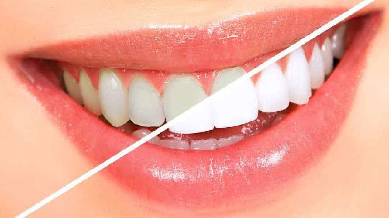 Teeth Whitening: ಬಾಯಿಯ ದುರ್ವಾಸನೆ ಮತ್ತು ಹಳದಿ ಹಲ್ಲುಗಳಿಗೆ ಇಲ್ಲಿವೆ ನೈಸರ್ಗಿಕವಾಗಿ ಮನೆಮದ್ದುಗಳು! Teeth Whitening: ಬಾಯಿಯ ದುರ್ವಾಸನೆ ಮತ್ತು ಹಳದಿ ಹಲ್ಲುಗಳಿಗೆ ಇಲ್ಲಿವೆ ನೈಸರ್ಗಿಕವಾಗಿ ಮನೆಮದ್ದುಗಳು!