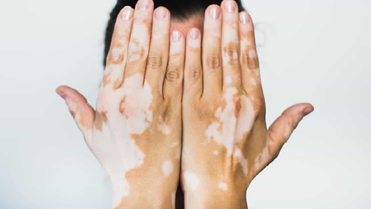 Vitiligo: ವಿಟಿಲಿಗೋ ಸಮಸ್ಯೆ ಇದ್ದವರು ಈ ಆಹಾರಗಳ ಸೇವನೆ ತಪ್ಪಿಸಿ Vitiligo: ವಿಟಿಲಿಗೋ ಸಮಸ್ಯೆ ಇದ್ದವರು ಈ ಆಹಾರಗಳ ಸೇವನೆ ತಪ್ಪಿಸಿ