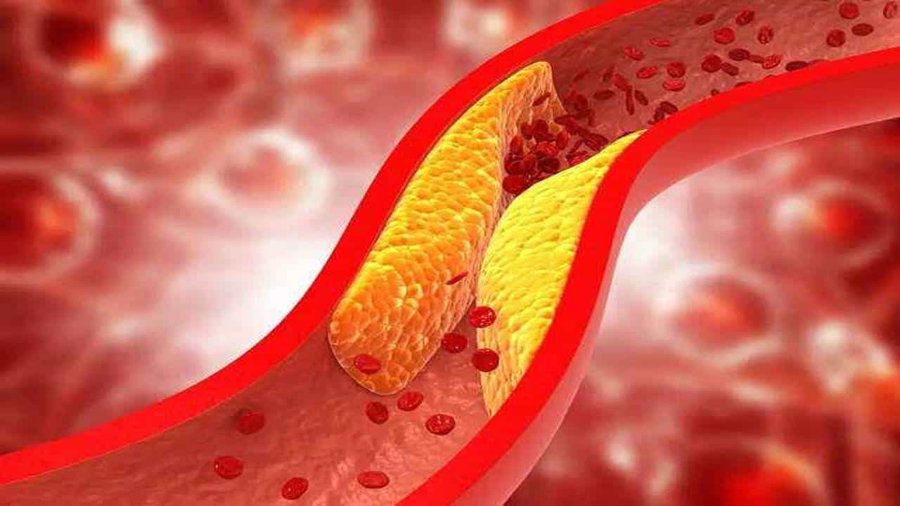 Cholesterol: ರಕ್ತನಾಳಗಳಲ್ಲಿ ಸಂಗ್ರಹವಾಗುವ ಕೊಲೆಸ್ಟ್ರಾಲ್ನಿಂದ ಹೃದಯ ಕಾಯಿಲೆಗಳು ಉಂಟಾಗಬಹುದು ಎಚ್ಚರ Cholesterol: ರಕ್ತನಾಳಗಳಲ್ಲಿ ಸಂಗ್ರಹವಾಗುವ ಕೊಲೆಸ್ಟ್ರಾಲ್ನಿಂದ ಹೃದಯ ಕಾಯಿಲೆಗಳು ಉಂಟಾಗಬಹುದು ಎಚ್ಚರ