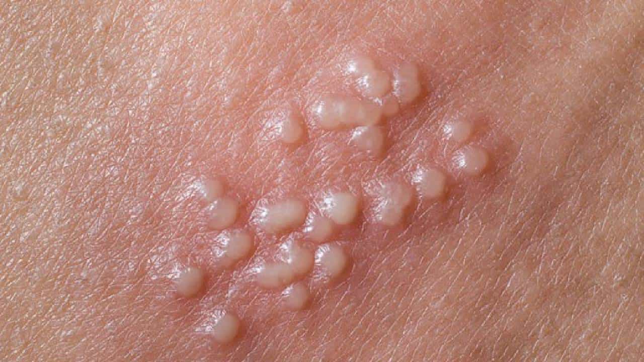 Herpes Simplex: ಅಗ್ನಿ ಸರ್ಪಸುತ್ತು ಎಂದರೇನು? ಸರ್ಪಸುತ್ತಿನ ವಿಧಗಳು, ಮನೆಮದ್ದುಗಳ ಕುರಿತು ಇಲ್ಲಿದೆ ಮಾಹಿತಿ Herpes Simplex: ಅಗ್ನಿ ಸರ್ಪಸುತ್ತು ಎಂದರೇನು? ಸರ್ಪಸುತ್ತಿನ ವಿಧಗಳು, ಮನೆಮದ್ದುಗಳ ಕುರಿತು ಇಲ್ಲಿದೆ ಮಾಹಿತಿ