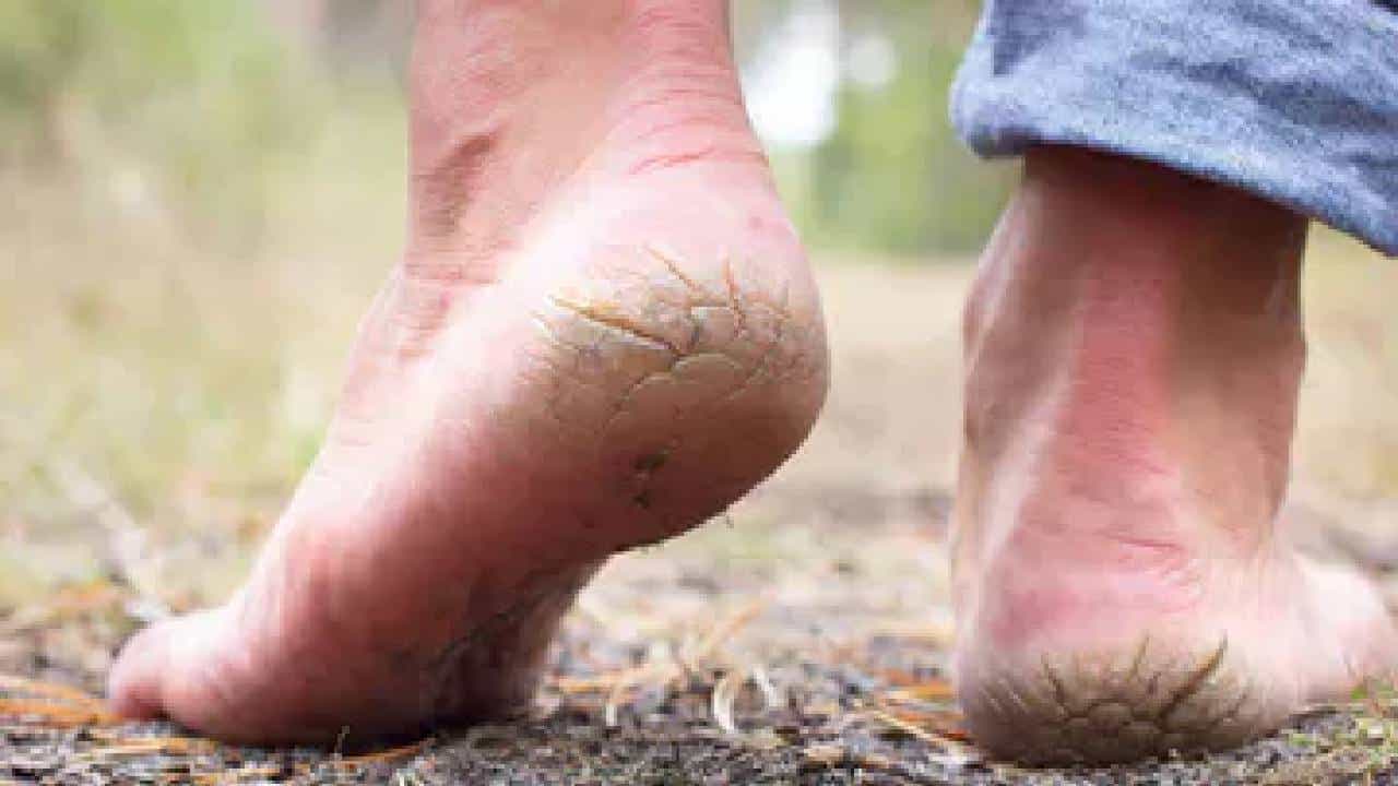 Cracked Heels: ಈ ವಿಟಮಿನ್ಗಳ ಕೊರತೆಯಿಂದ ಹಿಮ್ಮಡಿ ಬಿರುಕು ಬಿಡಬಹುದು, ಕೂಡಲೇ ಆಹಾರ ಕ್ರಮ ಬದಲಿಸಿಕೊಳ್ಳಿ Cracked Heels: ಈ ವಿಟಮಿನ್ಗಳ ಕೊರತೆಯಿಂದ ಹಿಮ್ಮಡಿ ಬಿರುಕು ಬಿಡಬಹುದು, ಕೂಡಲೇ ಆಹಾರ ಕ್ರಮ ಬದಲಿಸಿಕೊಳ್ಳಿ