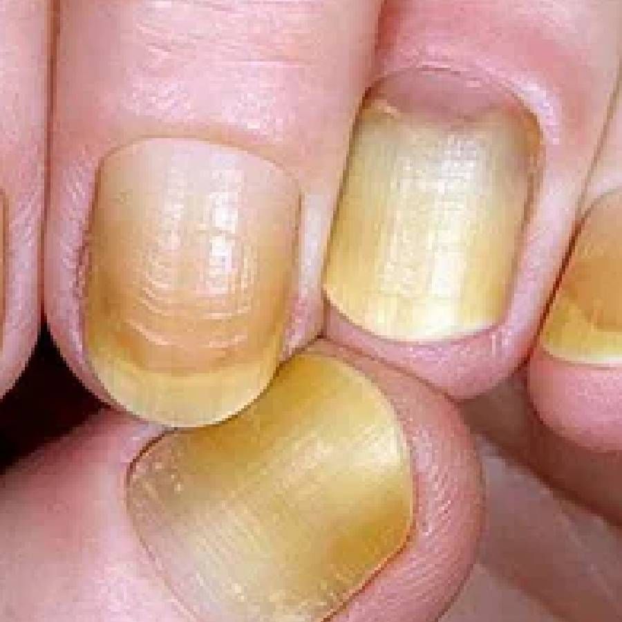 ಹಳದಿ ಉಗುರುಗಳು(Yellow nails): ನಿಮ್ಮ ಉಗುರುಗಳು ಹಳದಿ ಬಣ್ಣವನ್ನು ಹೊಂದಿದ್ದರೆ ಆರೋಗ್ಯವಾಗಿಲ್ಲ ಎಂದರ್ಥ. ಈ ಲಕ್ಷಣಗಳು ನಿಮ್ಮಲ್ಲಿ ಕಂಡುಬಂದಿದ್ದರೆ ಕೆಟ್ಟ ಕೊಲೆಸ್ಟ್ರಾಲ್ ಹೆಚ್ಚಾಗಿದೆ ಸೂಚಿಸುತ್ತದೆ. ಆದಷ್ಟು ಉಗುರುಗಳನ್ನುಧೂಳು, ಕೊಳೆಗಳಿಂದ ಸ್ವಚ್ಚವಾಗಿಟ್ಟುಕೊಳ್ಳುವುದು ಉತ್ತಮ.
