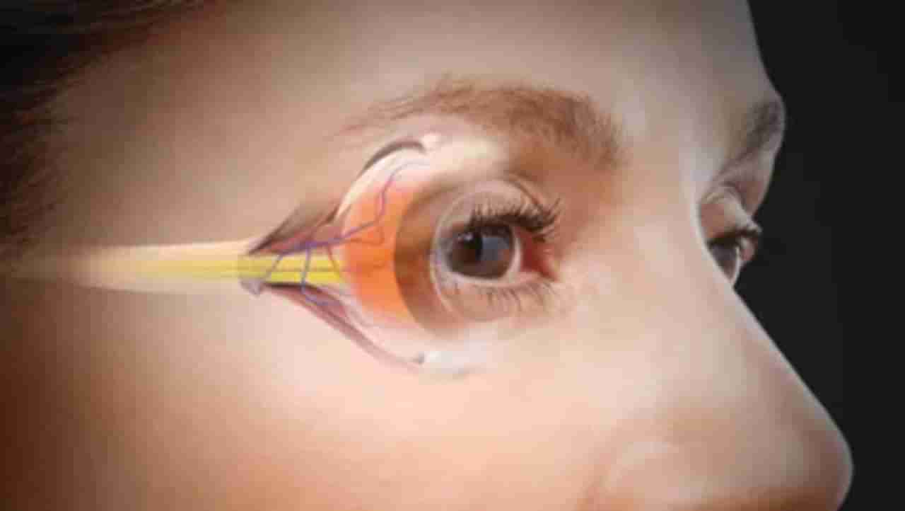 Cataract: ಆರಂಭಿಕ ಕಣ್ಣಿನ ಪೊರೆಯಂತಹ ಸಮಸ್ಯೆಗೆ ಇಲ್ಲಿದೆ ತಜ್ಞರ ಸಲಹೆ